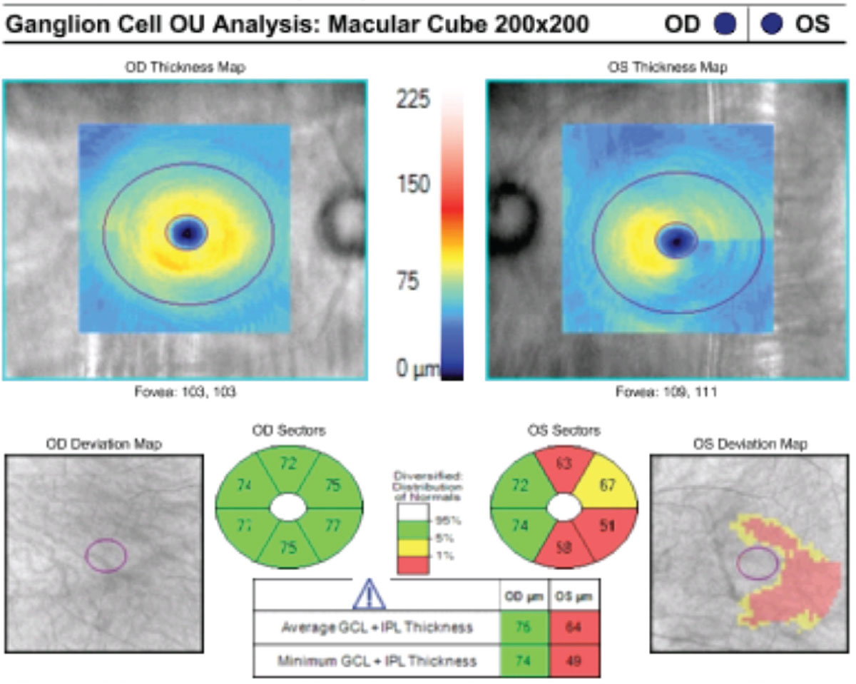 This patient’s macular GCC OCT indicates reduced GCL and IPL thickness in their left glaucomatous eye.