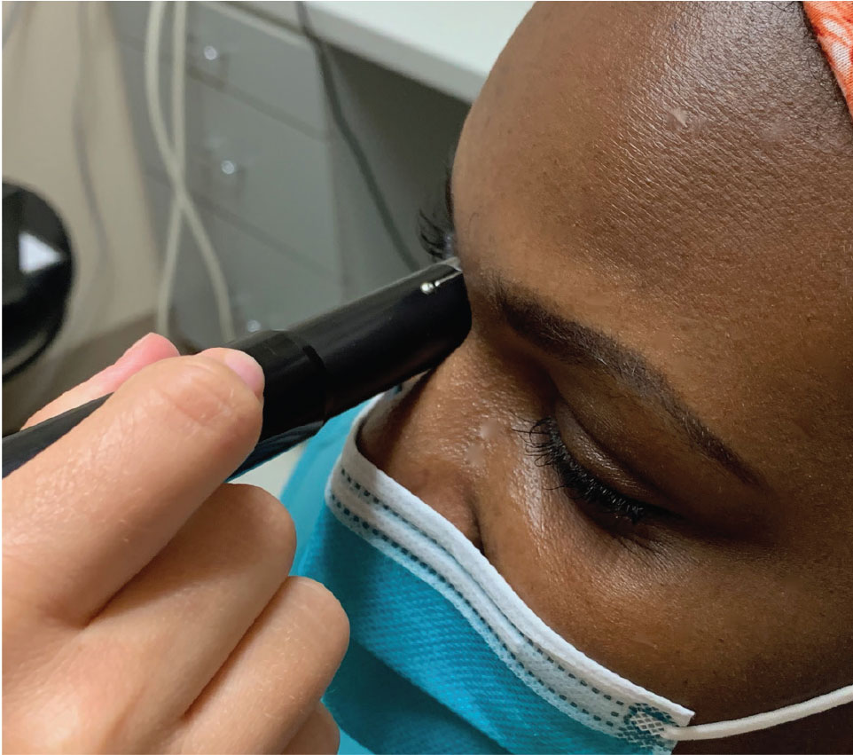 Here the clinician is capturing the transverse B-scan of 9 o’clock (T9). The probe is placed over the upper lid with the marker directed superiorly while the patient looks to the right.