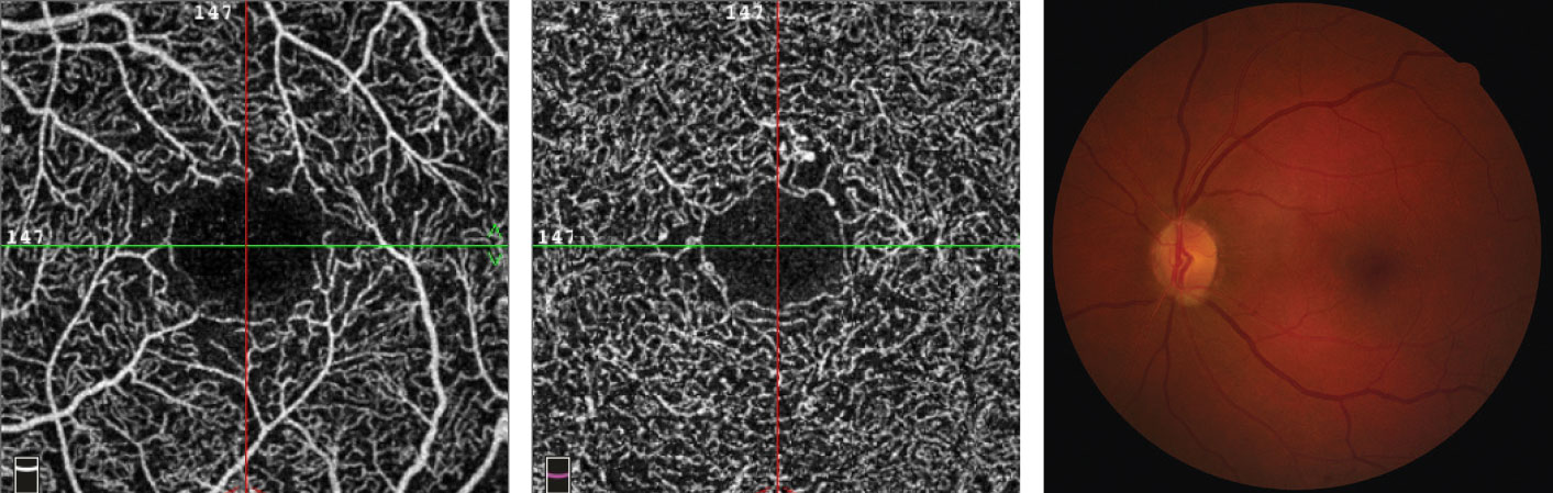 This 65-year-old female with a 14-year history of diabetes shows no signs of retinopathy on fundus imaging, right. However, she has an HbA1C of 6.8% with unknown daily blood sugar levels. Her SCP OCT-A images, left, and DCP B-scans, center, show an enlarged FAZ with indistinct borders, capillary non-perfusion surrounding the fovea with scattered areas devoid of flow and microaneurysms.