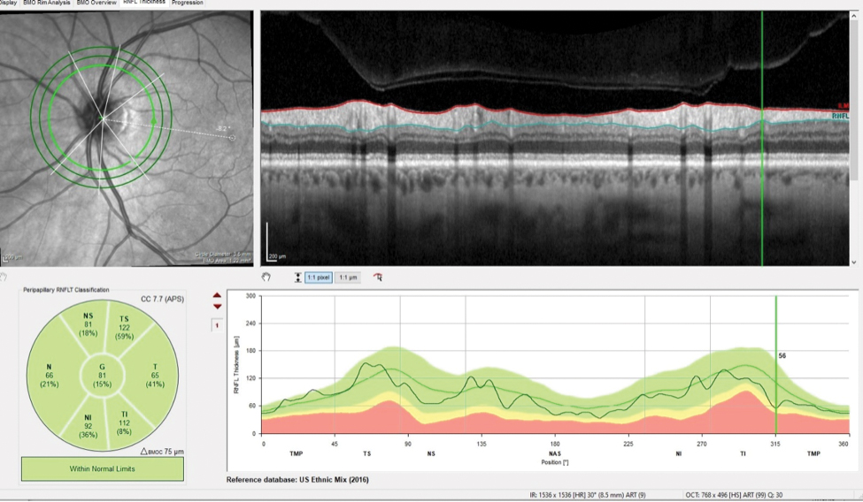 Fig. 2. The patient’s inferotemporally thinned RNFL in the area of the wedge defect measured 56μm.