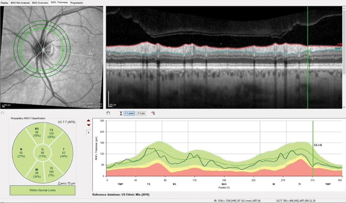 Fig. 4. Note the difference of only 4μm in the wedge defect and overall stability in this follow-up scan of the perioptic RNFL.