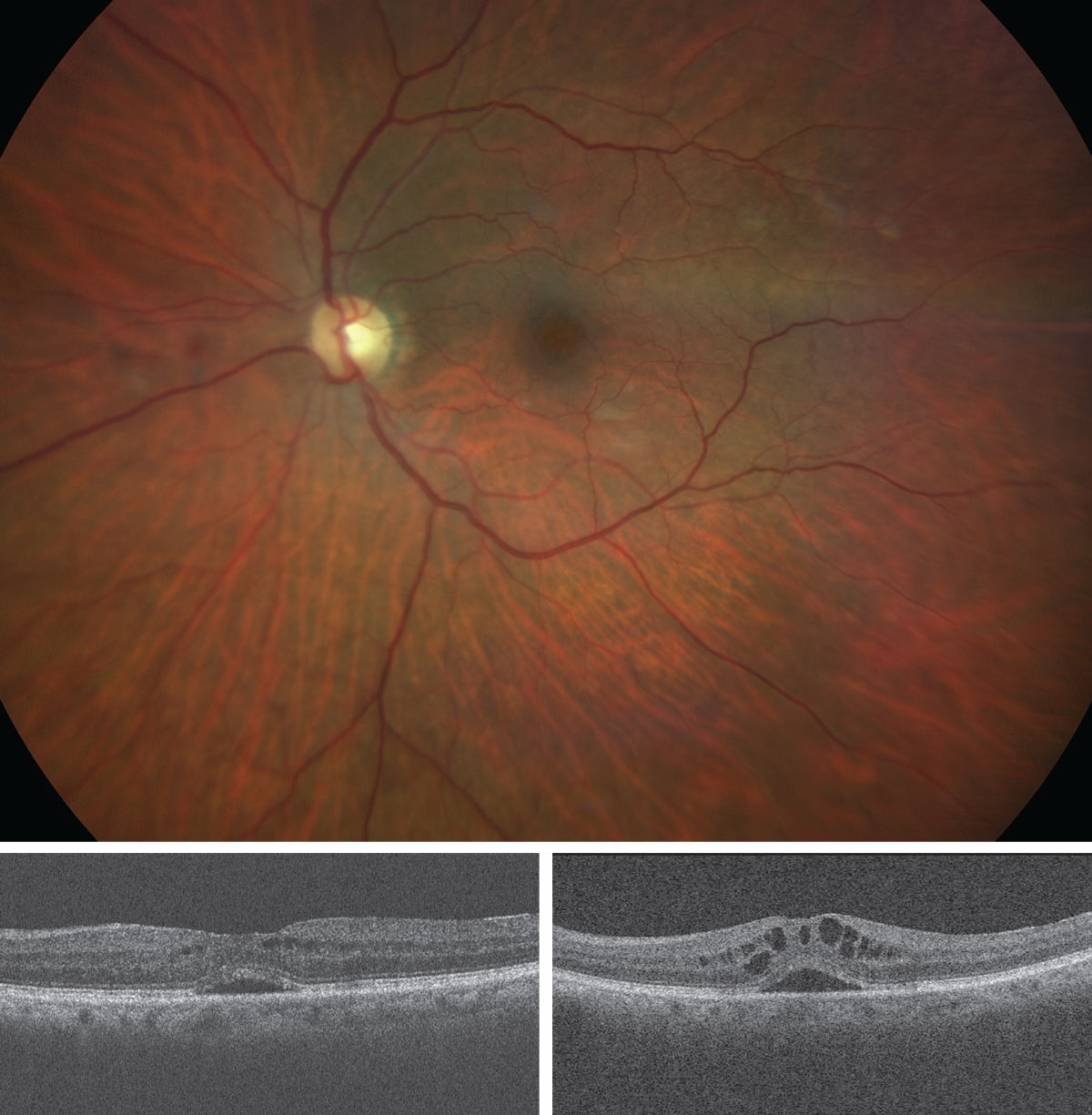 What do these findings suggest about the patient? How would you approach management? 