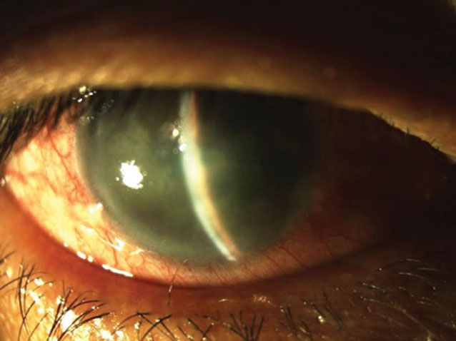 Corneal edema in acute angle-closure attack.