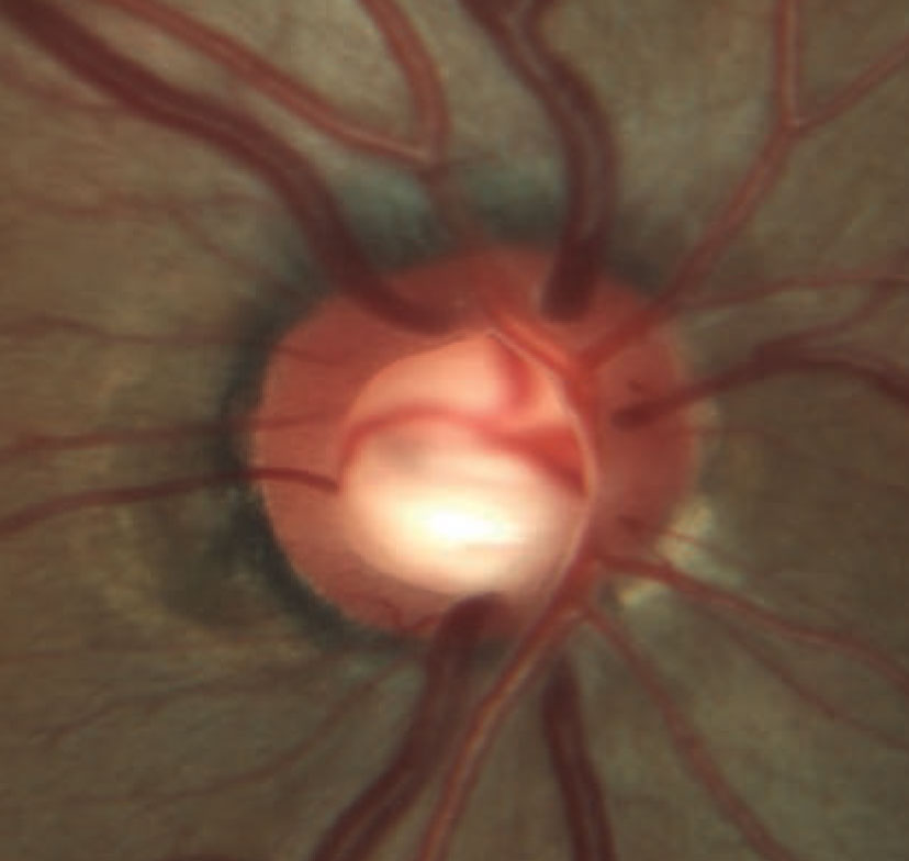 Rim erosion and laminar remodeling in a patient with POAG. The total number of identified POAG loci has increased to 74 in the past few years, enhancing our understanding of the genetic aspects of this condition.