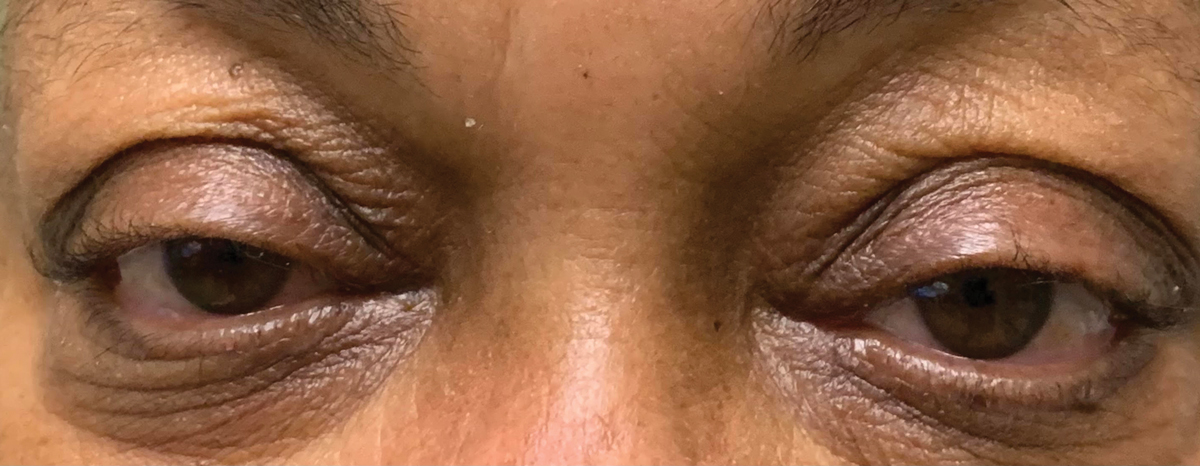 Mild ptosis secondary to sympathetic dysfunction.