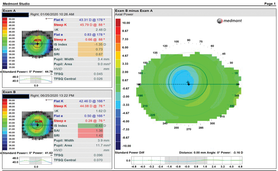 Fig. 1. Subtractive axial maps in a successful ortho-K fit show successful reduction of refractive error and a well-centered treatment zone over the pupil.