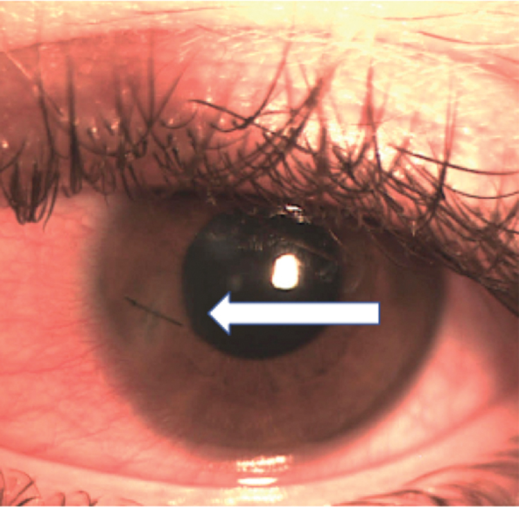 A strategically placed suture can help close a leaking wound.