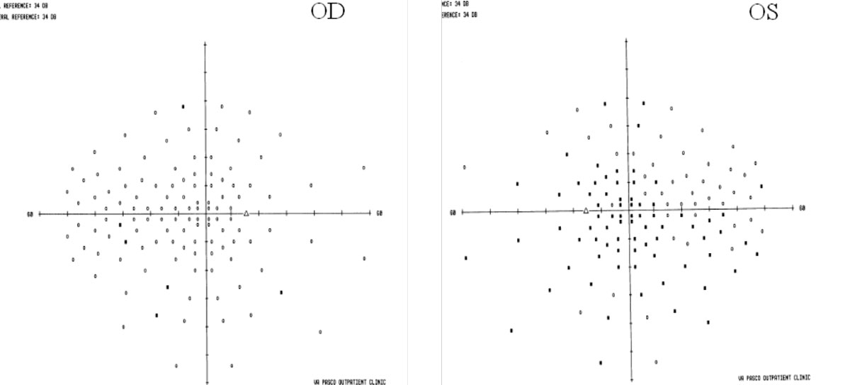 In MS, visual fields may show areas that aren’t a clear as others.