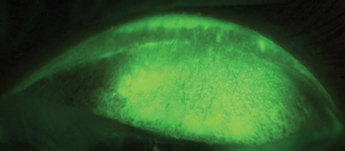 Fig. 3. LWE is apparent after staining with NaFl.