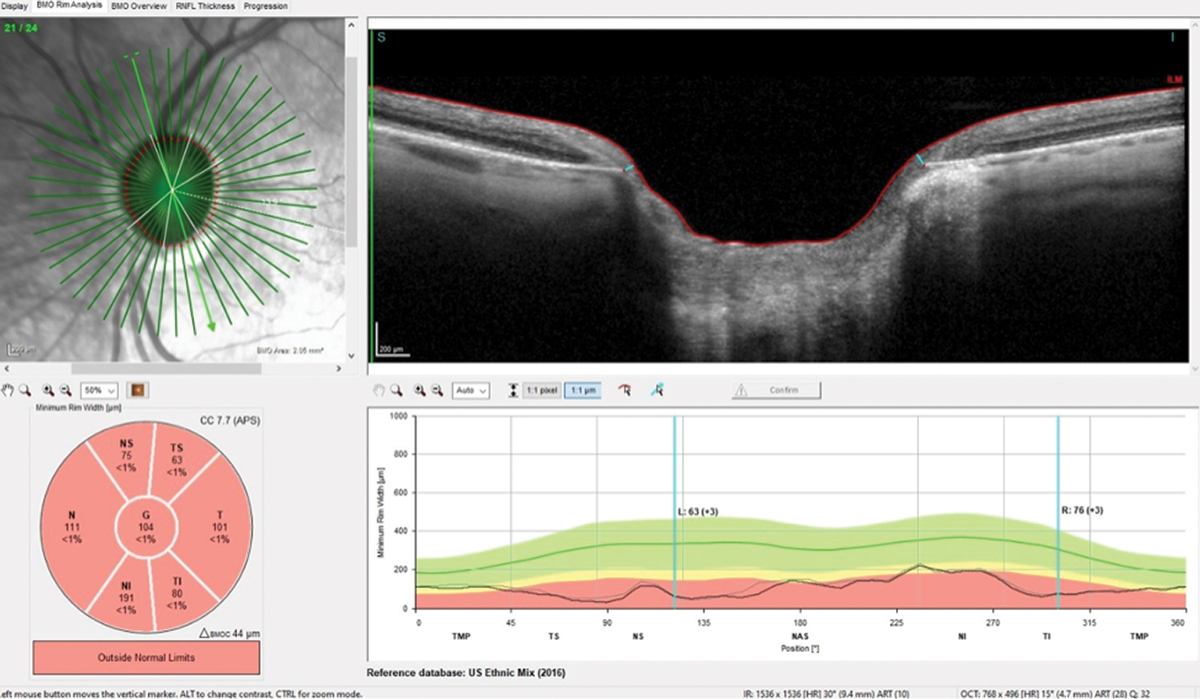 Note the exceedingly thin neuroretinal rim, especially in the temporal portion of the optic nerve, consistent with advanced damage OS.