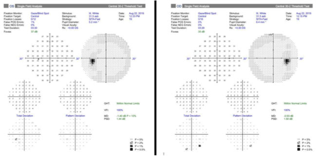 Fig. 2. Results of 30-2 Humphrey visual fields at the initial visit were within normal limits.