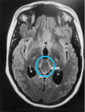 Fig. 4. MRI revealed a large pineal cyst (blue circles).