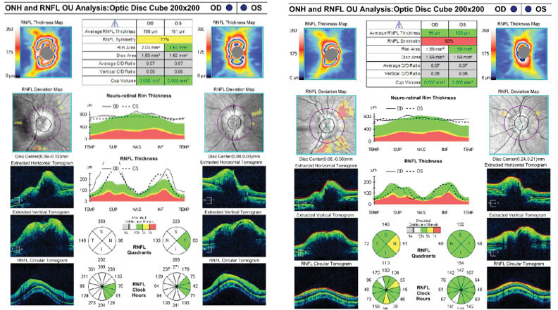 Figs. 5a & 5b. RNFL scans at two weeks (left) and two months (right) post-surgery revealed initial worsening and subsequent improvement of disc edema.