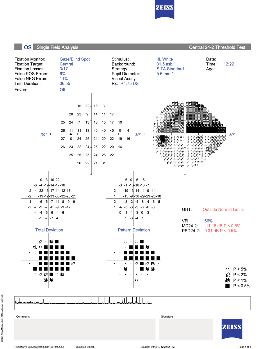 There are three points to keep in mind when interpreting this 24-2 SITA Standard printout:  1.	The test is reliable, without excessive fixation losses, false positive or false negative errors. 2.	The total deviation plot reveals highly significant depression over nearly the entire field. When adjusting for this overall depression, which was due to cataract, the pattern deviation plot shows a large, dense superior arcuate defect with a smaller inferior nasal step. This pattern of loss is characteristic of glaucoma. 3.	The GHT is outside normal limits due to the significant difference between the superior and inferior hemifield values; the MD and PSD are both highly abnormal.