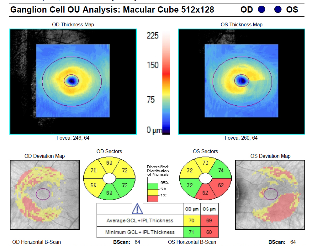 The patient shows the classic ganglion cell–inner plexiform layer thinning in the inferotemporal sector of the macula of the left eye.