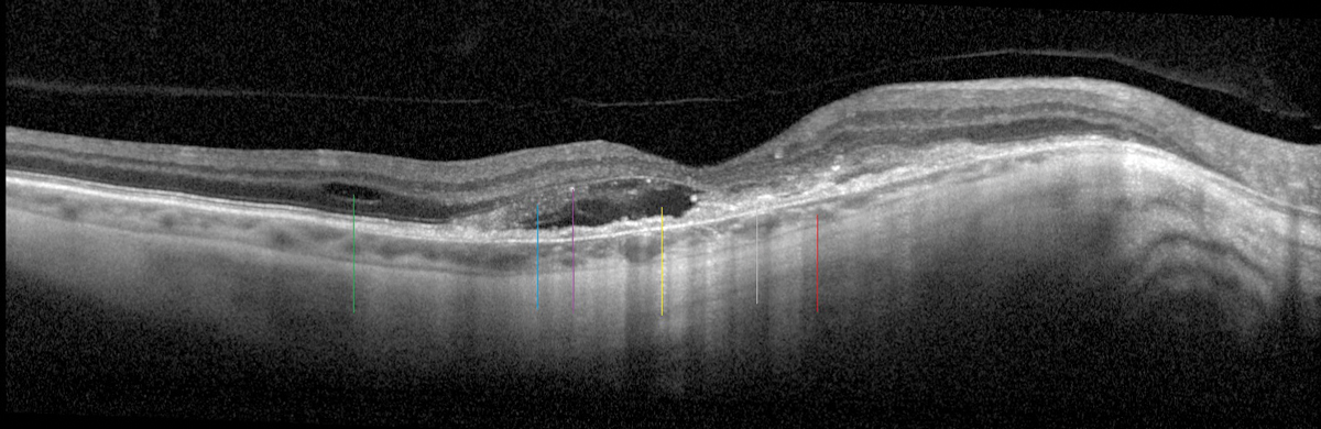 Fig 4. A highly myopic patient with a tessellated and thin choroid (red line), RPE disruption (gray line), SRF (yellow line), IRF (green line), edematous photoreceptors (blue line) with early tubulation and hyperreflective material (purple line) are all consistent with myopic CNV.