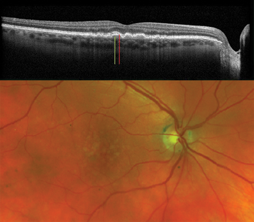 Figs. 7a and 7b. Soft drusen (green line) with drusenoid PEDs (red line). Clinical photo of the large soft drusen (bottom).