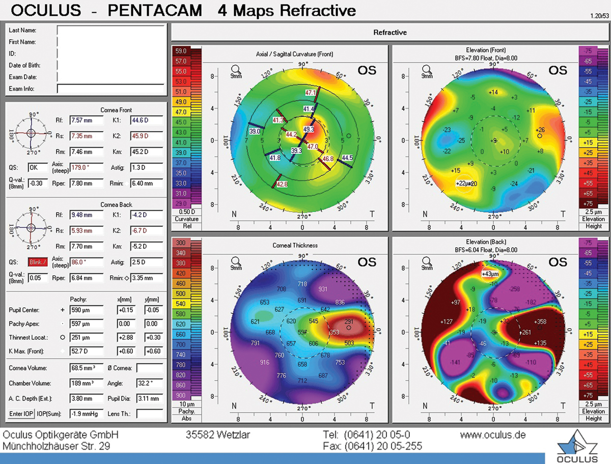 Irregular astigmatism on topography in a patient with OSD.