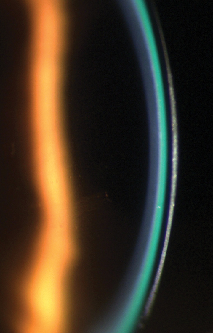 A scleral lens demonstrating a 1:1 ratio of lens thickness (dark band) to tear layer (green band).