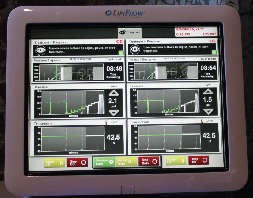 LipiFlow established the concept of combining heat and pressure for gland expression, and the system offers practitioners useful feedback during the procedure.