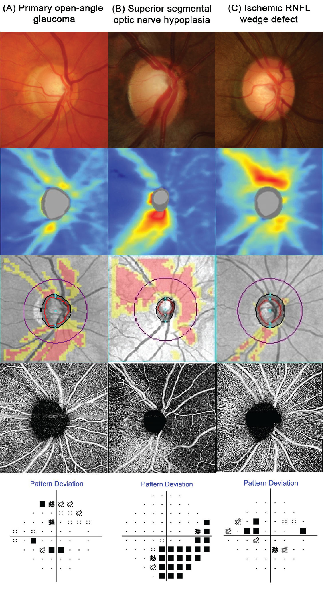 Fig. 1. Funduscopic and OCT findings for three contrasting patients