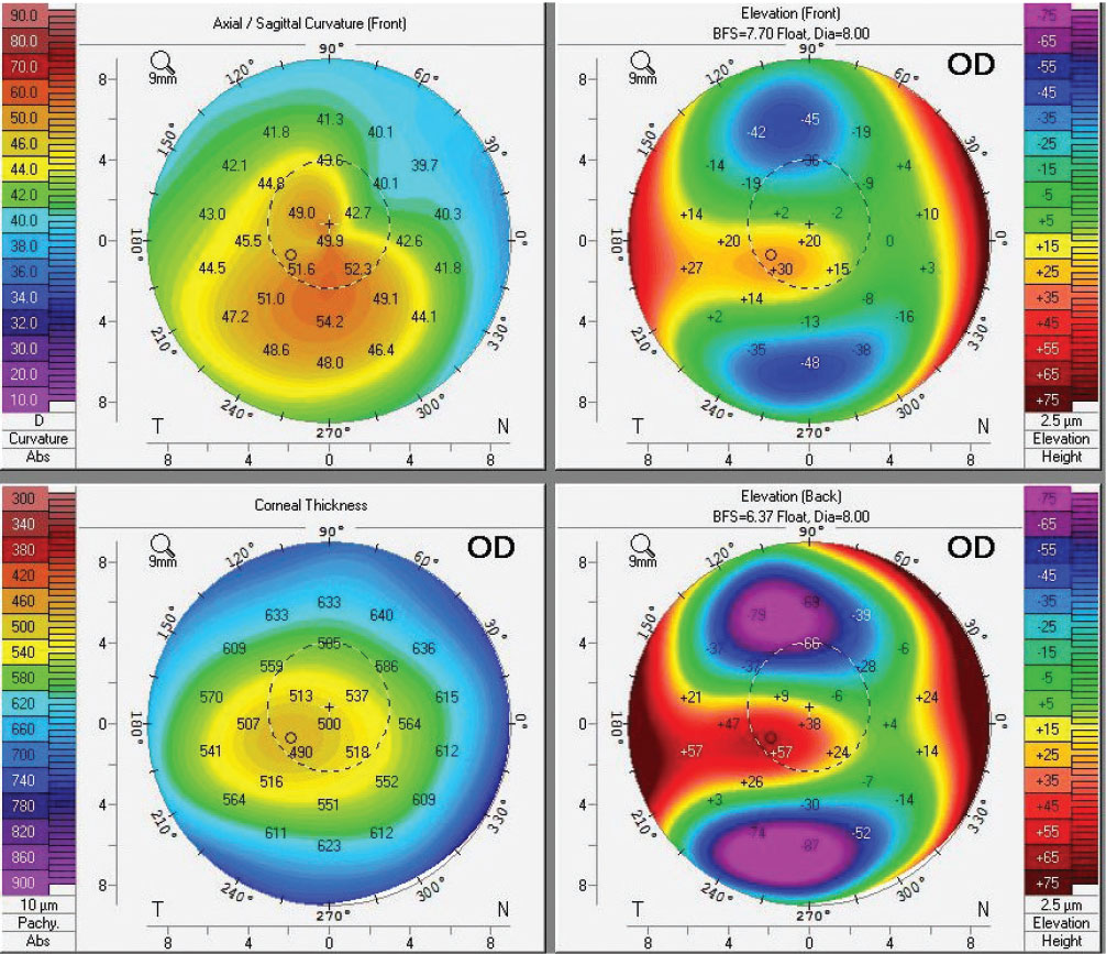 Despite moderate keratoconus, this eye sees relatively well with glasses at 20/25-. Fortunately for the patient, the primary OD was suspicious for keratoconus due to high astigmatism and a reduction in best-corrected acuity and sent them for evaluation The Pentacam shows deviations with topography, pachymetry, and anterior and posterior elevations that makes the diagnosis clear cut. The patient was able to be crosslinked and maintains good acuity because their primary OD managed the eye perfectly.