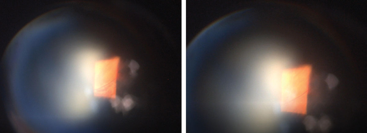 What might these unusual fundus images reveal about our patient? Left: lesion with off-axis 90° view. Right: lesion with digital pressure applied to the globe.