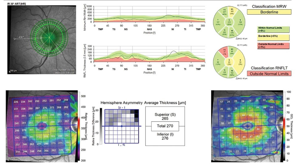 Here’s an overview of the three areas to observe when monitoring for disease progression: the neuroretinal rim, circumpapillary RNFL and macular region. Existing damage in this case can be readily seen in both the macular ganglion cell layer and the superior temporal RNFL.