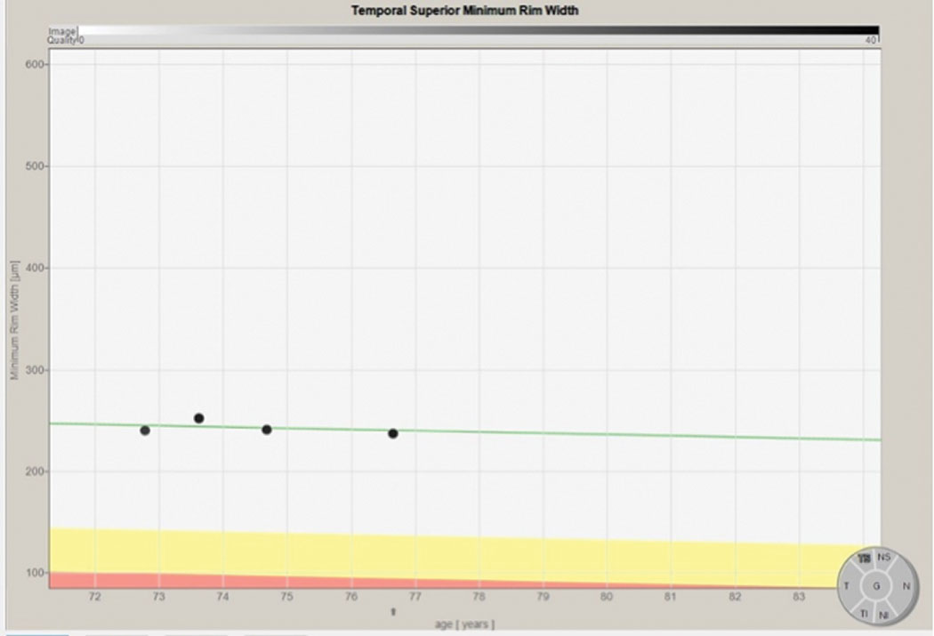 Progression analysis of the superior temporal sector of the neuroretinal rim over four scans spanning four years. The progression follows the expected gradual decline over time as noted by the green line. This indicates a normal situation and not significant glaucoma progression.