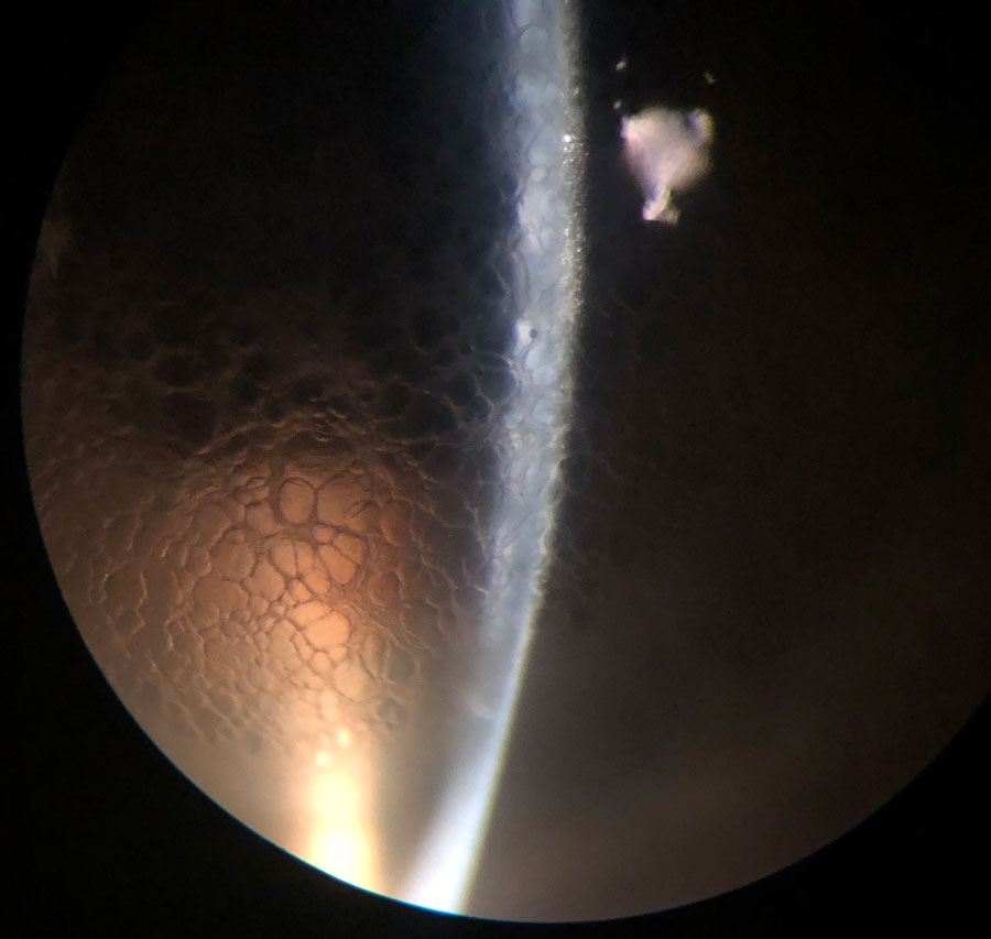  Optic section of same patient. Note the honeycomb is confined to the epithelial layer.