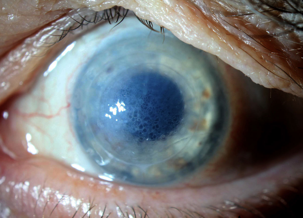 Honeycomb edema in a patient using off-label Rhopressa once daily as a medical tamponade in a failed DSAEK under PK.