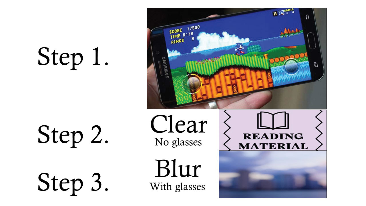 The patient’s description of events: iPhone video play, followed by ability to read without reading glasses but distance vision blur.