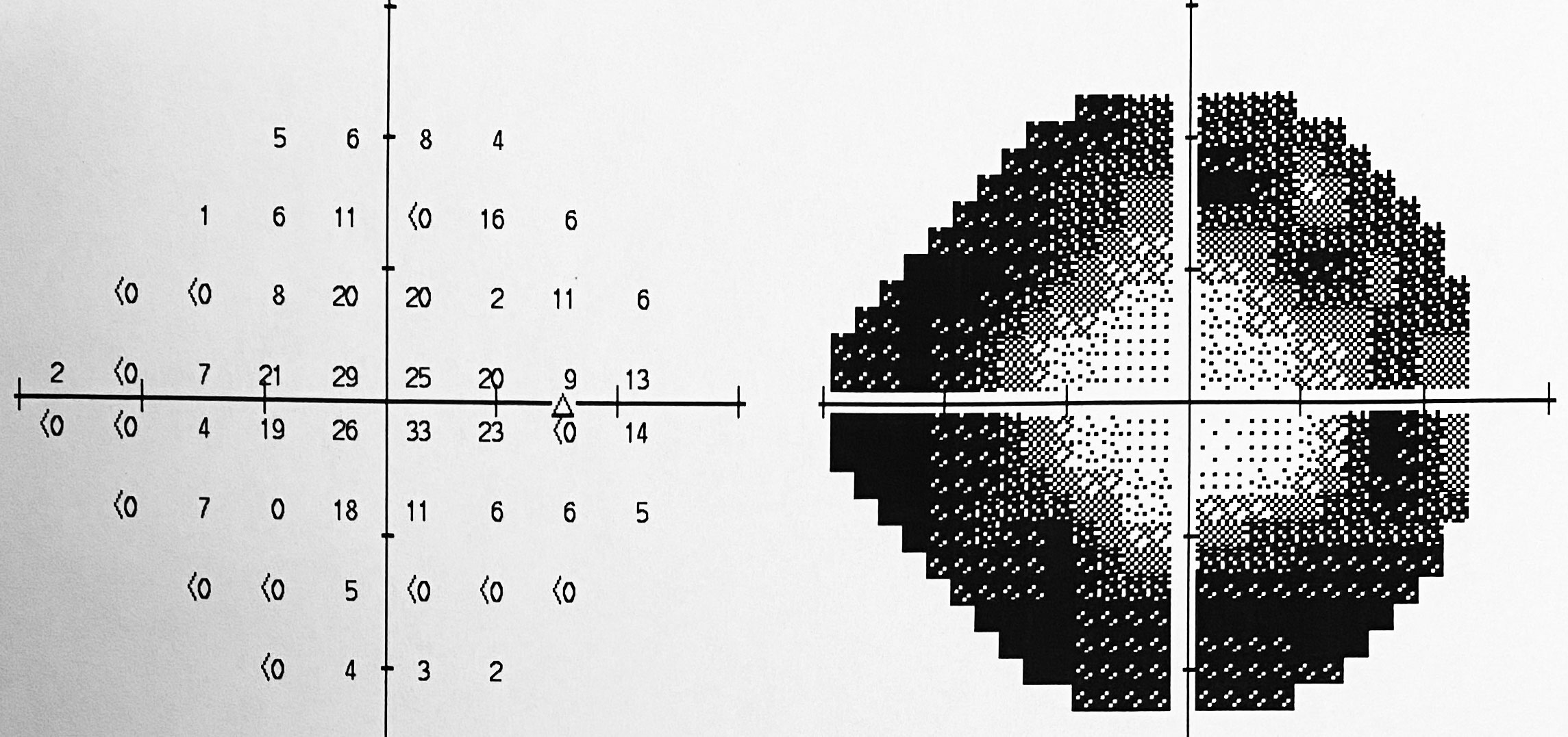 VF reveals peripheral vision loss.