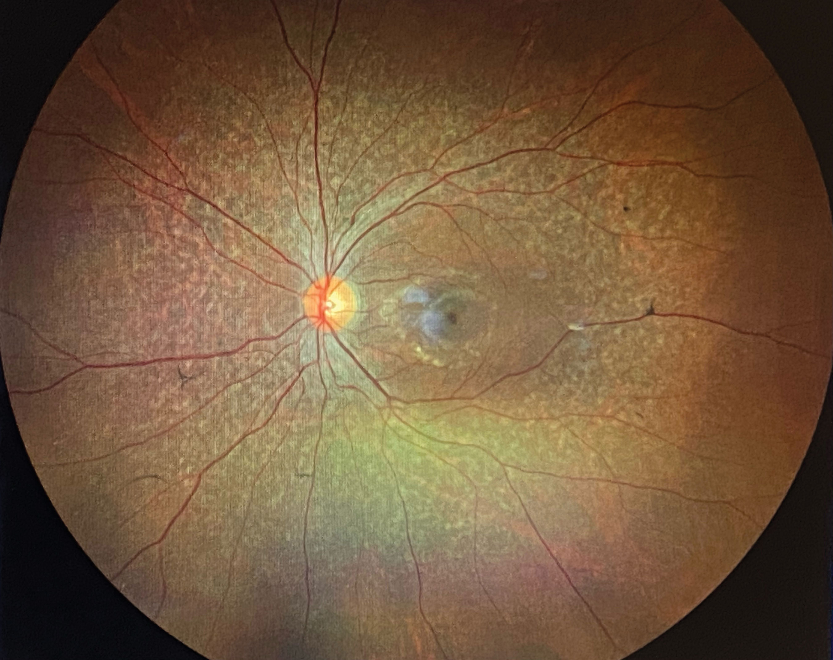 Bone spicules are a common finding of most RP patients.