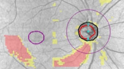 The PanoMap feature on the Zeiss Cirrus OCT (left) exhibits thinning of both the retinal nerve fiber layer and ganglion cell layer-inner plexiform layer complex with a corresponding visual field result (right) showing a superior nasal step defect.