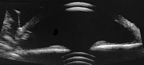 Fig. 1. Reverberations of sound waves can be seen from the dislocated posterior chamber IOL/capsular bag complex behind the iris.