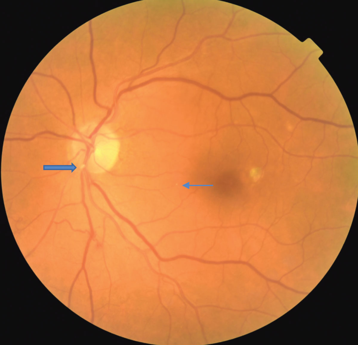 A fibrinogen platelet embolus is seen at the location of the large blue arrow. A small Hollenhorst plaque is seen at the small blue arrow.