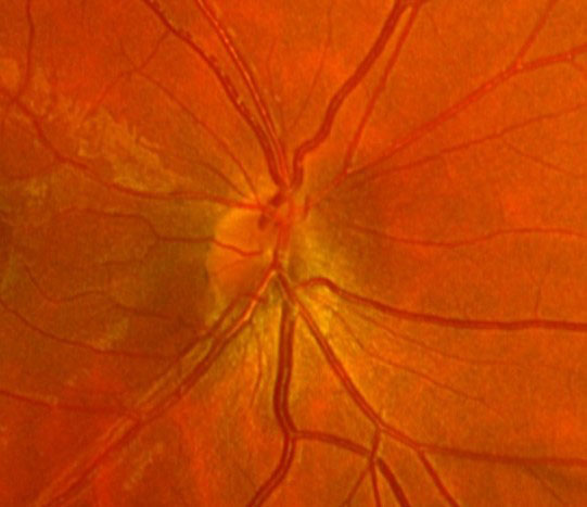 Figs. 1 (top) and 2 (bottom). VF and OCT as well as fundus images are useful in diagnosing SSOH.