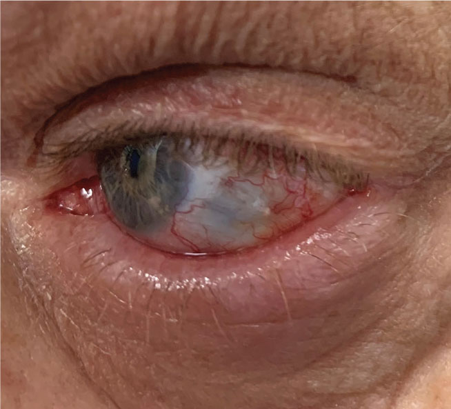 Scleral thinning in a patient with scleritis.