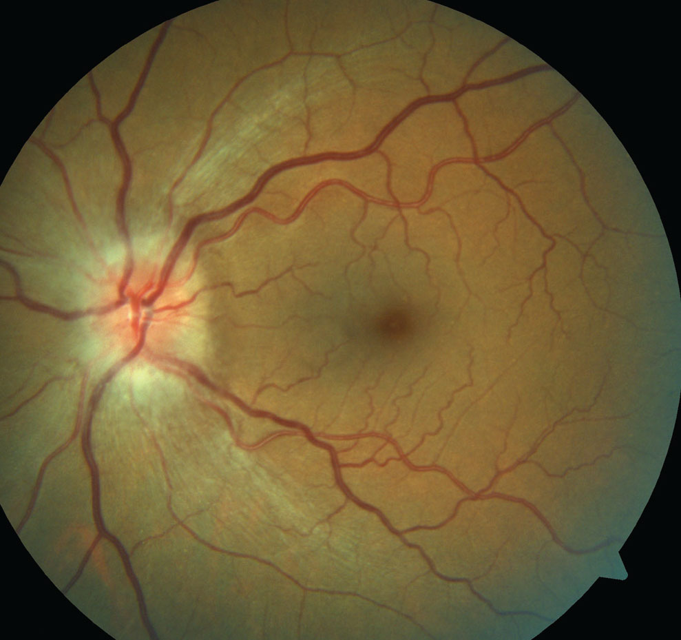 Note the hyperemic disc edema in this patient presenting with NAION.