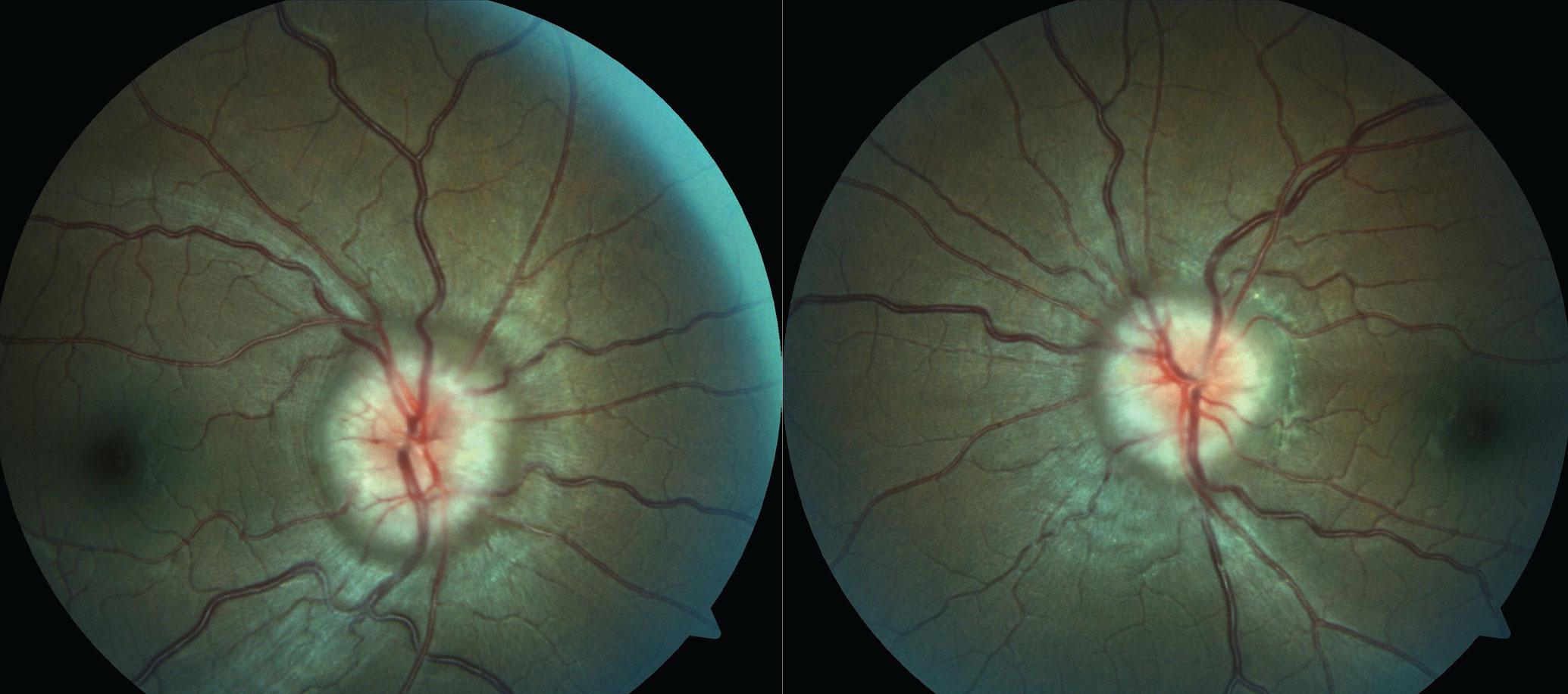 In this patient with papilledema secondary to PTC, the diagnosis cannot be confirmed without normal MRI/MRV and after lumbar puncture has been performed.