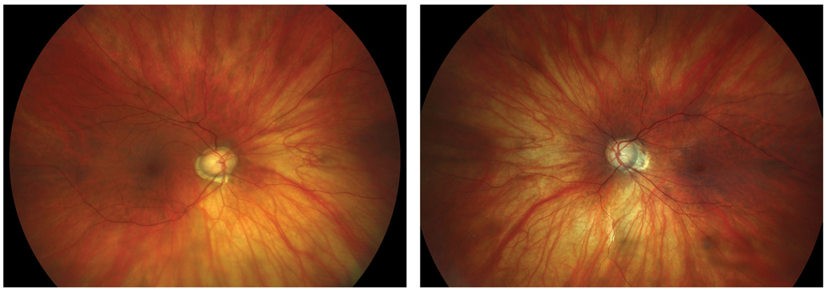 Figs. 1 and 2. Large discs and cups in a highly myopic patient.