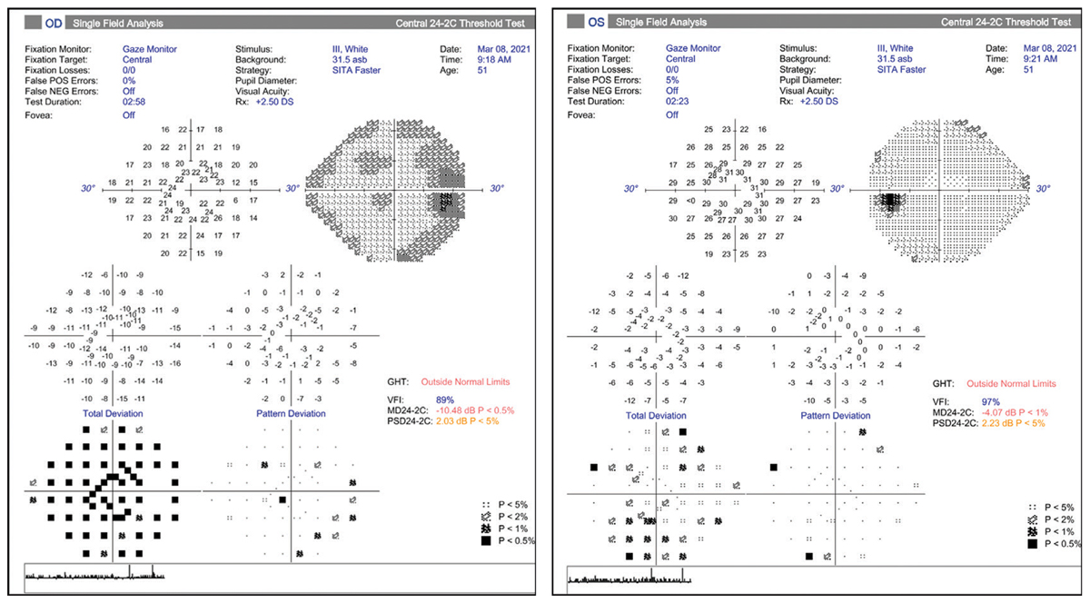 Figs. 4 and 5. Visual fields do not show loss that corresponds to RNFL loss indicated in Fig. 3.