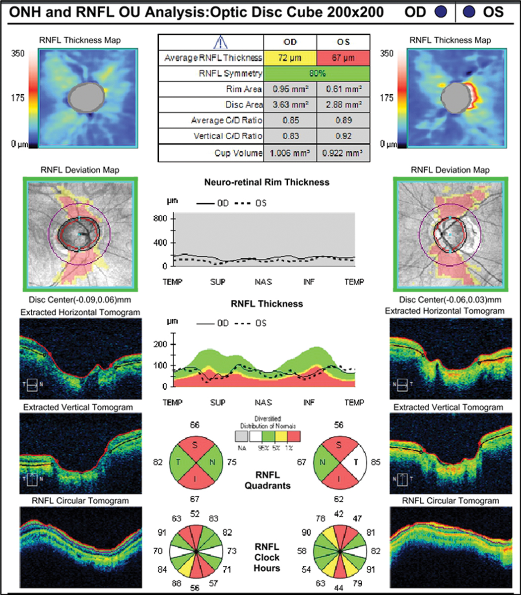 Fig. 3. RNFL analysis shows vertical thinning but confirms large disc diameter OD>OS.