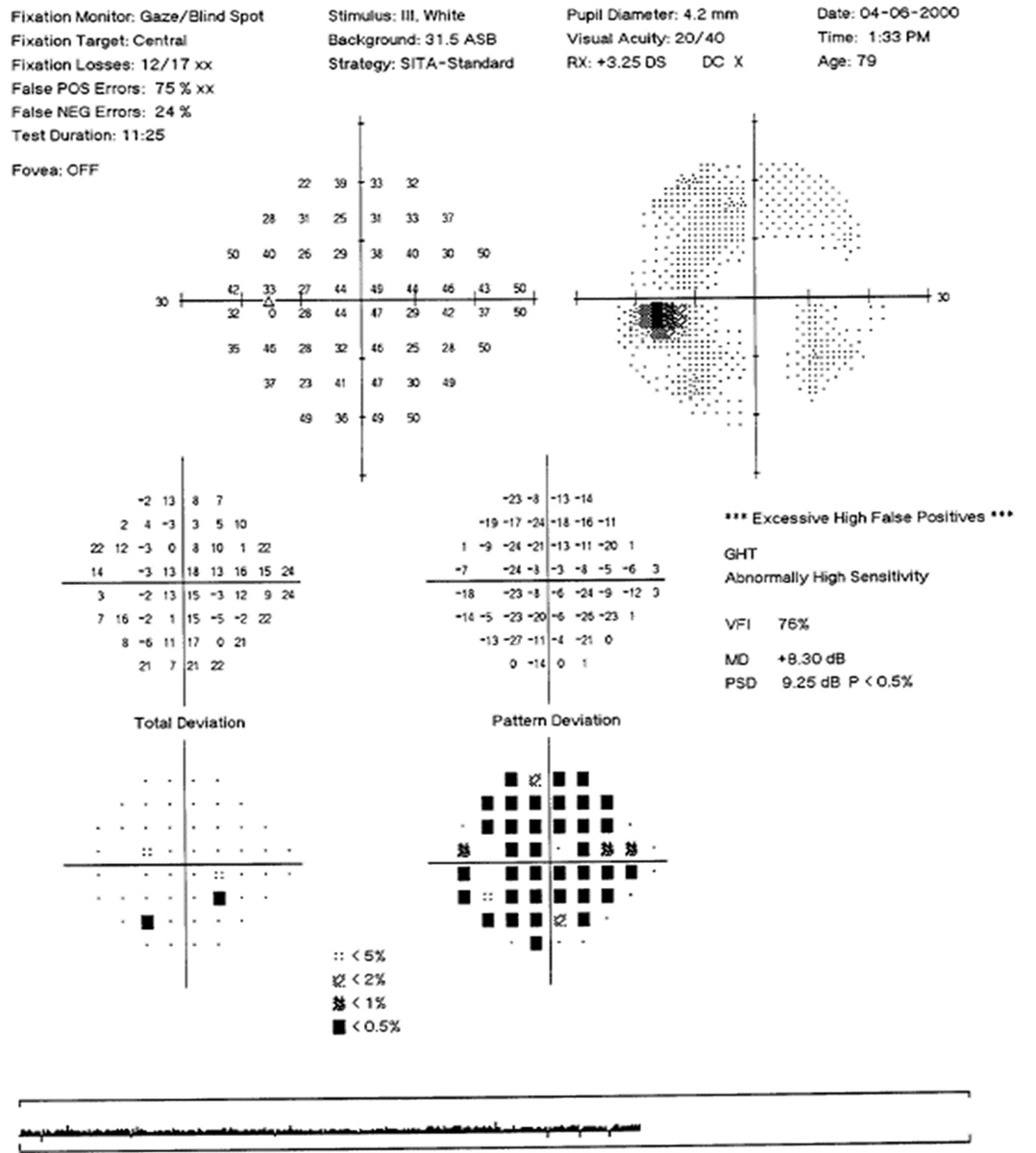 Fig. 6. Visual field of left eye with high false positives and a “reverse cataract” pattern.