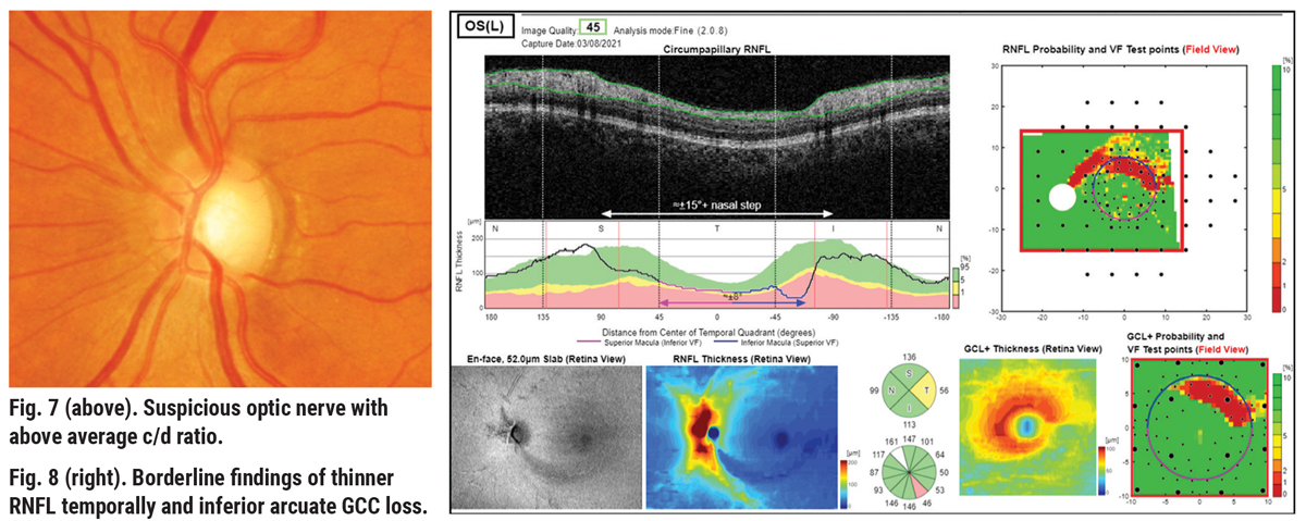 Fig. 7 (above). Suspicious optic nerve with above average c/d ratio. Fig. 8 (right). Borderline findings of thinner RNFL temporally and inferior arcuate GCC loss.