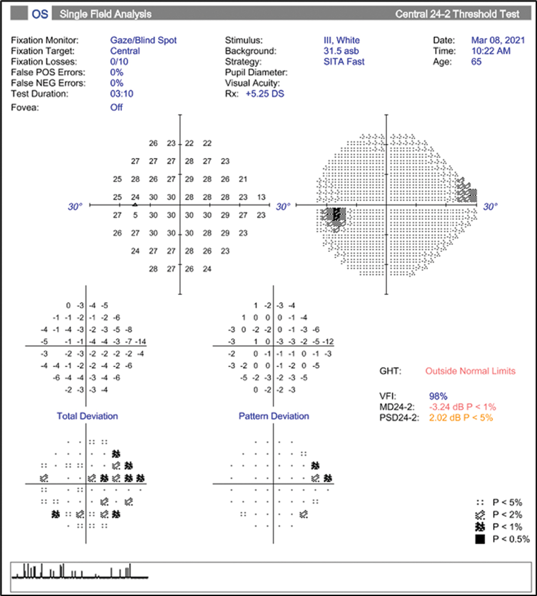 Fig. 9. Reliable HVF showing possible early superior nasal step in the left eye.