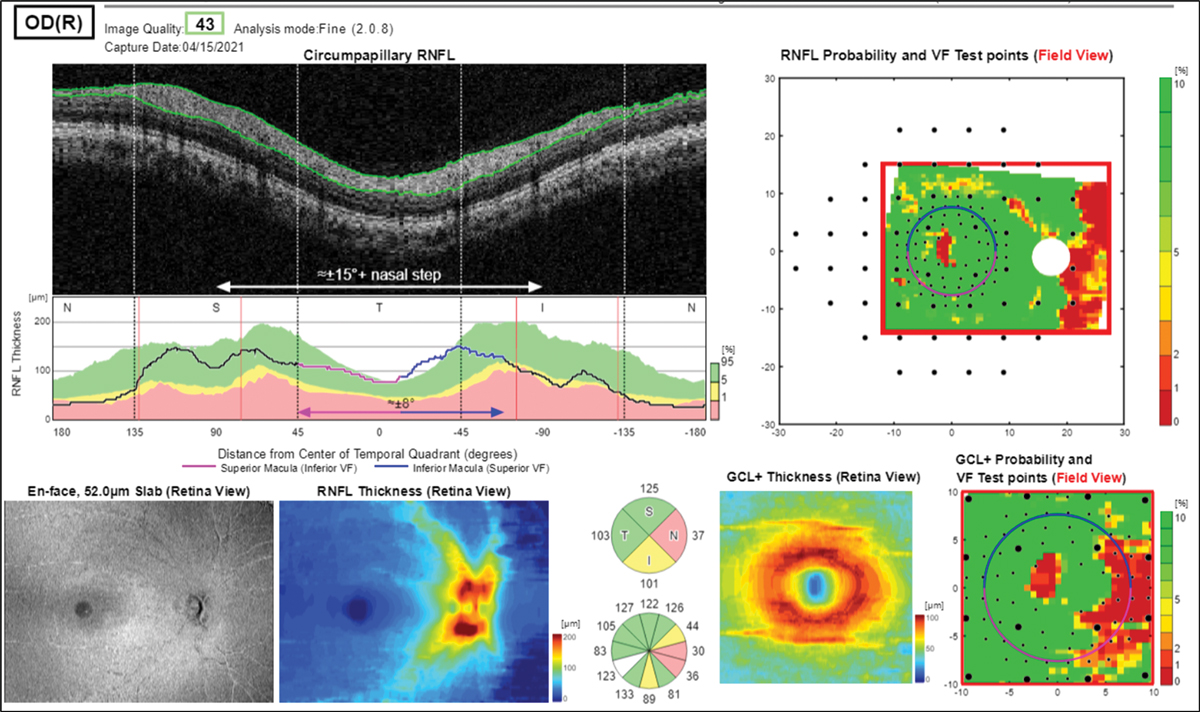 Fig. 20. RNFL analysis shows “red disease,” non-glaucomatous abnormality to the nasal disc area.