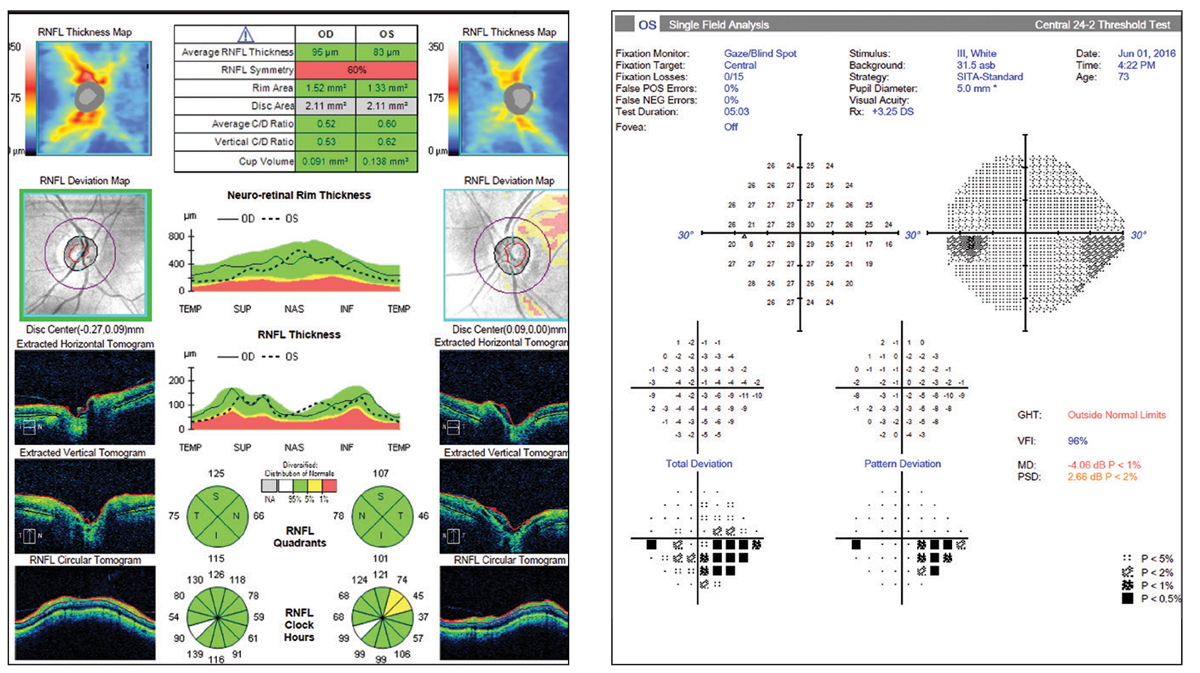 Figs. 22 and 23. So-called “green disease.” Average RNFL thickness value is color-coded green and within normal range per the reference database. However, the OCT report shows a superior temporal focal defect and the visual field shows a correlating defect.