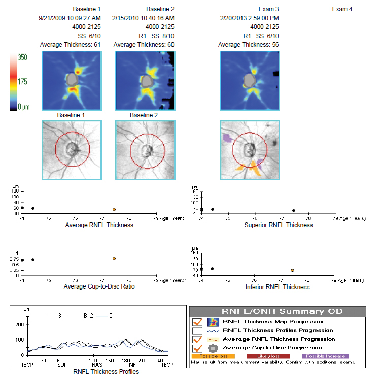 Fig. 24.  RNFL OCT demonstrating the “floor effect.”